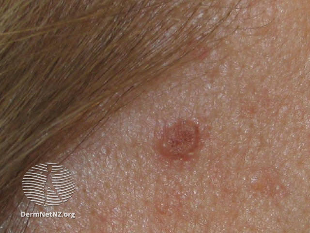 File:Basal cell carcinoma affecting the face (DermNet NZ lesions-bcc-face-0714).jpg