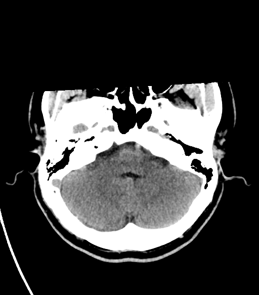 File:Basal ganglia hemorrhage - hypertensive (Radiopaedia 42227-45304 Axial non-contrast 7).png