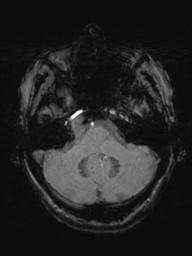 Base of skull chondrosarcoma (Radiopaedia 30410-31070 Axial SWI 14).jpg