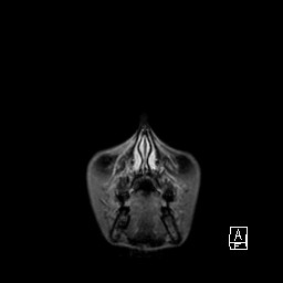 Base of skull rhabdomyosarcoma (Radiopaedia 32196-33142 I 10).jpg