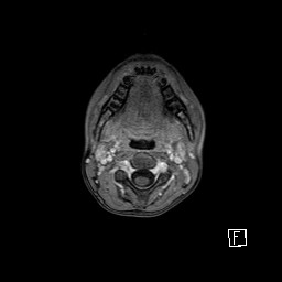 Base of skull rhabdomyosarcoma (Radiopaedia 32196-33142 T1 C+ fat sat 9).jpg