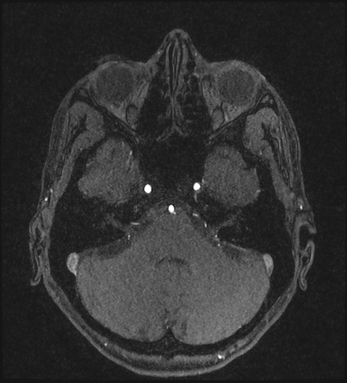 Basilar artery perforator aneurysm (Radiopaedia 82455-97733 Axial MRA 65).jpg