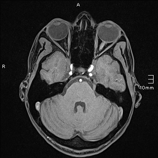 Basilar artery perforator aneurysm (Radiopaedia 82455-99523 F 36).jpg