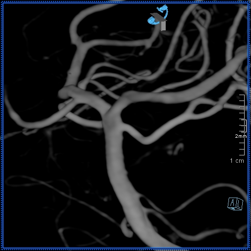 Basilar artery perforator aneurysm (Radiopaedia 82455-99524 3D Left VA 34).jpg