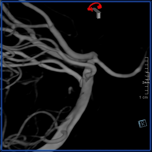 Basilar artery perforator aneurysm (Radiopaedia 82455-99524 3D Left VA 68).jpg
