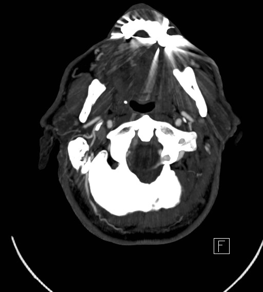Basilar artery thrombosis (Radiopaedia 26986-27163 A 7).jpg