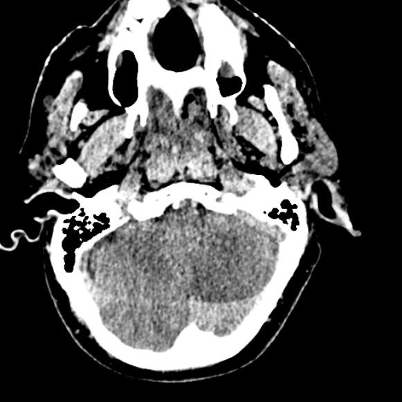 Basilar artery thrombosis (Radiopaedia 53351-59333 Axial non-contrast 31).jpg