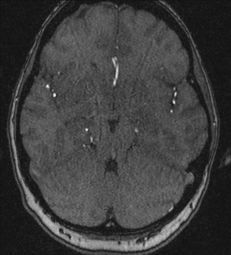 Basilar tip aneurysm (Radiopaedia 26504-26632 MRA 87).jpg