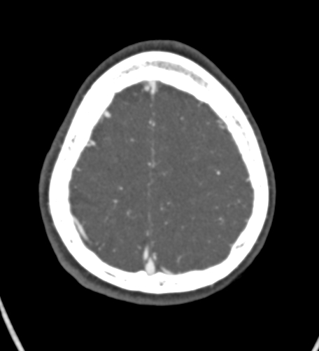 Basilar tip aneurysm with coiling (Radiopaedia 53912-60086 A 125).jpg