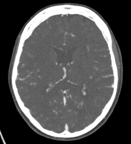 Basilar tip aneurysm with coiling (Radiopaedia 53912-60086 A 85).jpg