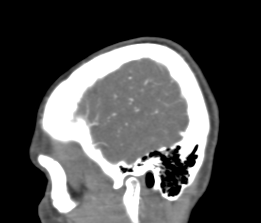 File:Basilar tip aneurysm with coiling (Radiopaedia 53912-60086 C 11).jpg
