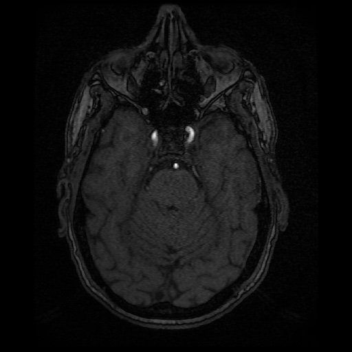 Basilar top and left middle cerebral artery aneurysm (Radiopaedia 61965-70031 Axial MRA 48).jpg