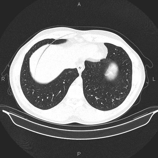 File:Beam hardening and ring artifacts (Radiopaedia 85323-100915 Axial lung window 62).jpg