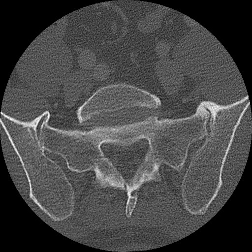 Benign post-traumatic pseudopneumoperitoneum (Radiopaedia 71199-81495 Axial bone window 286).jpg