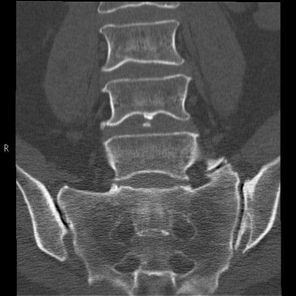 Bertolotti syndrome (Radiopaedia 24864-25128 Coronal bone window 22).jpg