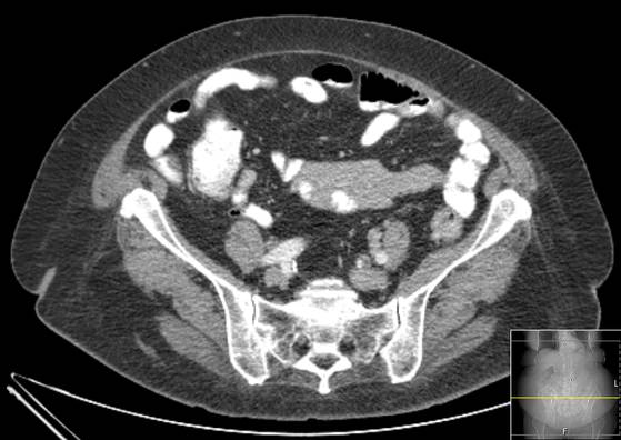 File:Bicameral celiacomesenteric aneurysm (Radiopaedia 55766-62327 A 49).jpg