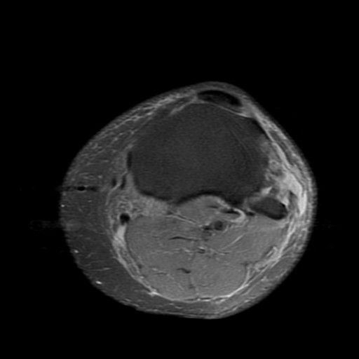 File:Biceps femoris distal tendon avulsion (Radiopaedia 15109-14987 Axial PD fat sat 22).jpg
