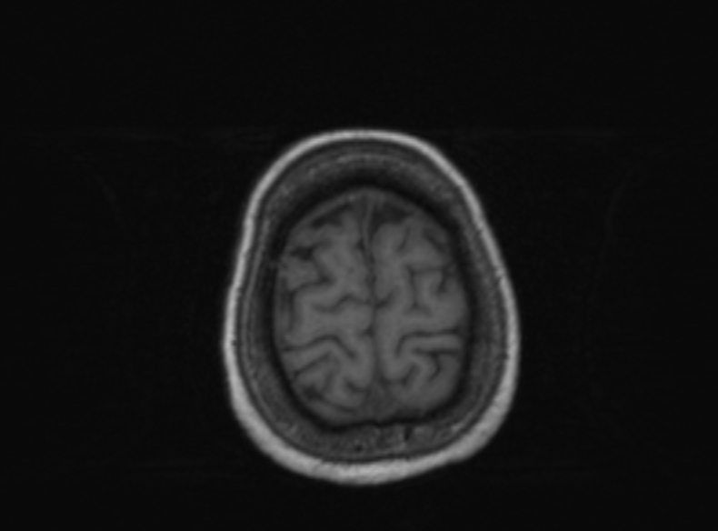 Bilateral PCA territory infarction - different ages (Radiopaedia 46200-51784 Axial T1 135).jpg