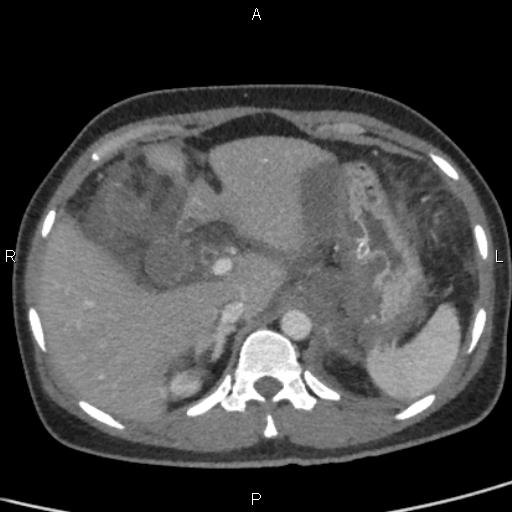 Bilateral adrenal gland hyperenhancement in pancreatitis (Radiopaedia 86642-102753 E 24).jpg