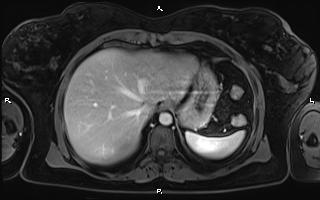Bilateral adrenal myelolipoma (Radiopaedia 63058-71537 G 18).jpg