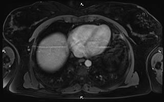 Bilateral adrenal myelolipoma (Radiopaedia 63058-71537 G 9).jpg