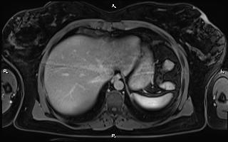 Bilateral adrenal myelolipoma (Radiopaedia 63058-71537 H 16).jpg