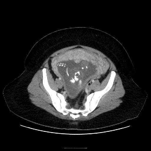 Bilateral adrenal thrombosis (Radiopaedia 58182-65256 A 62).jpg