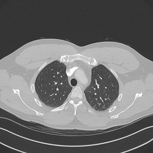 Bilateral atelectasis (Radiopaedia 48666-53675 Axial lung window 27).jpg