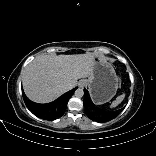 Bilateral benign adrenal adenomas (Radiopaedia 86912-103124 Axial C+ delayed 6).jpg