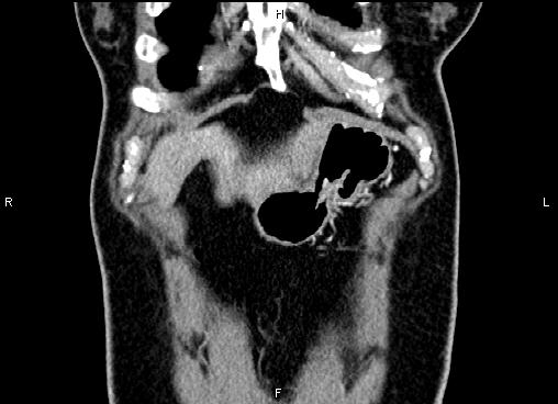 Bilateral benign adrenal adenomas (Radiopaedia 86912-103124 D 5).jpg