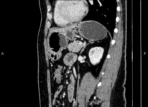 Bilateral benign adrenal adenomas (Radiopaedia 86912-103124 E 63).jpg