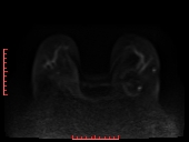 File:Bilateral breast implant rupture (Radiopaedia 24761-25027 DWI 15).jpg