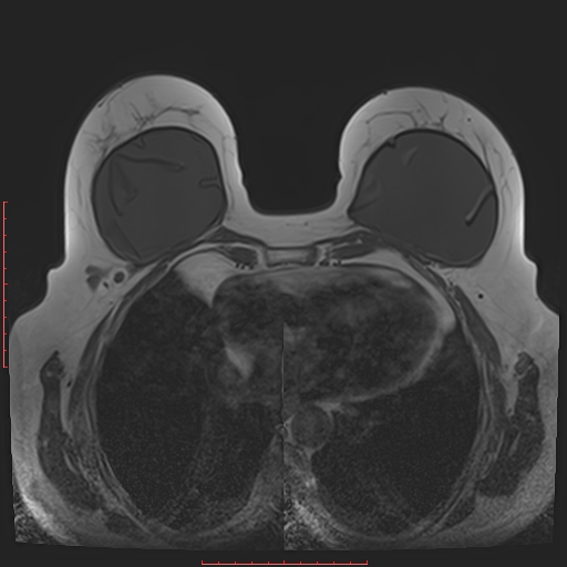 File:Bilateral breast implant rupture (Radiopaedia 24761-25027 T1 23).jpg