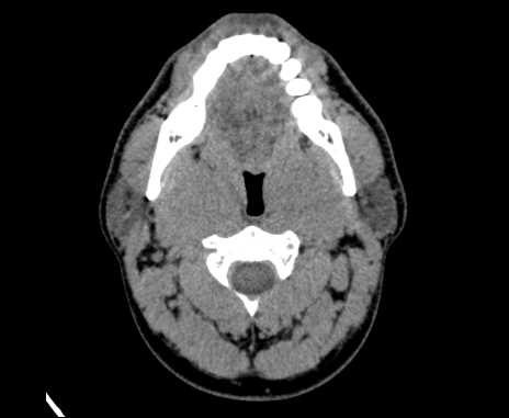 Bilateral carotid body tumors (Radiopaedia 61841-69870 Axial non-contrast 33).jpg