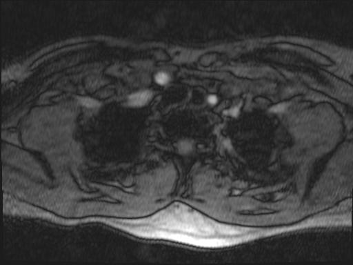 Bilateral carotid body tumors and right glomus jugulare tumor (Radiopaedia 20024-20060 Axial MRA 181).jpg