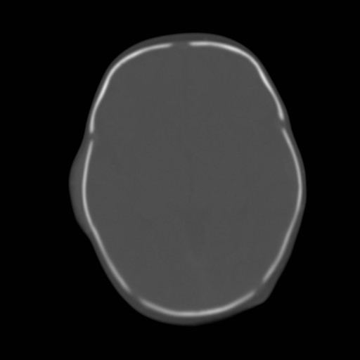 File:Bilateral cephalohematomas and subdural hematomas (Radiopaedia 26778-26929 Axial bone window 12).jpg