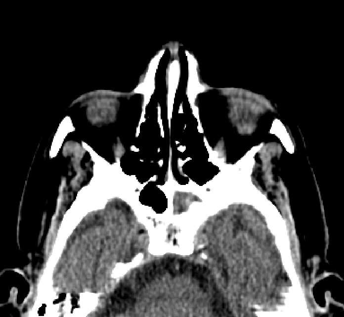 Bilateral ectopia lentis (Radiopaedia 89889-107013 Axial non-contrast 62).jpg
