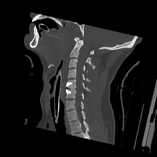 Bilateral locked facets (Radiopaedia 33850-35023 Sagittal bone window 33).png