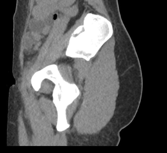 Bilateral mature cystic ovarian teratoma (Radiopaedia 88821-105592 D 62).jpg