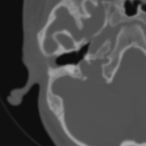Bilateral otosclerosis (Radiopaedia 57237-64157 B 43).jpg