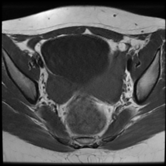 File:Bilateral ovarian fibrothecomas - adolescent (Radiopaedia 86604-102707 Axial T1 16).jpg