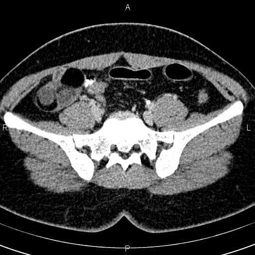 Bilateral ovarian teratoma (Radiopaedia 83131-97503 B 20).jpg