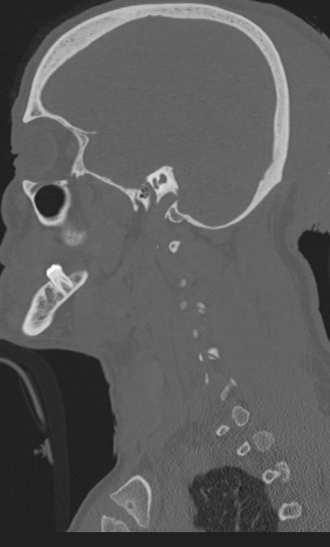 Bilateral perched facet joint (Radiopaedia 63149-71669 Sagittal bone window 67).jpg