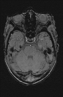 Bilateral subdural hemorrhage and parietal skull fracture (Radiopaedia 26058-26190 Axial SWI 18).png
