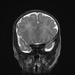 File:Bilateral subdural hemorrhage and parietal skull fracture (Radiopaedia 26058-26190 Coronal T2 9).png