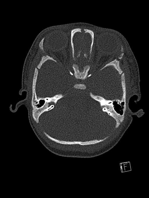 Bilateral subdural hemorrhage and parietal skull fracture (Radiopaedia 26058-26192 Axial bone window 102).png