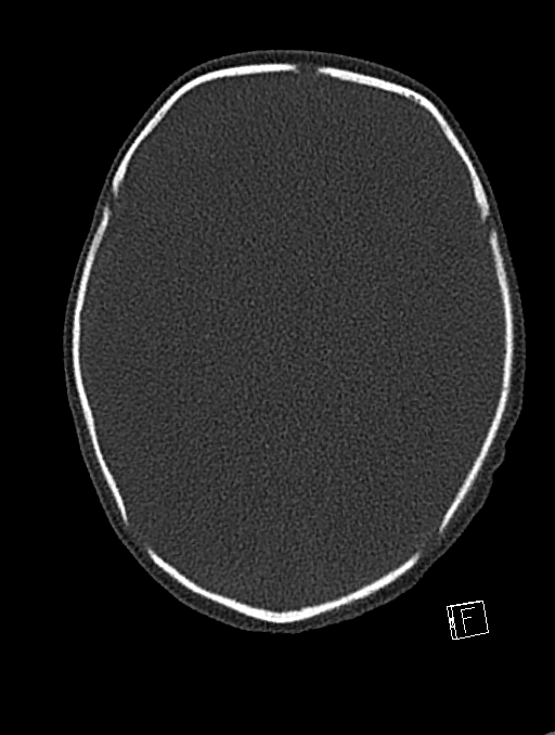 Bilateral subdural hemorrhage and parietal skull fracture (Radiopaedia 26058-26192 Axial bone window 73).png