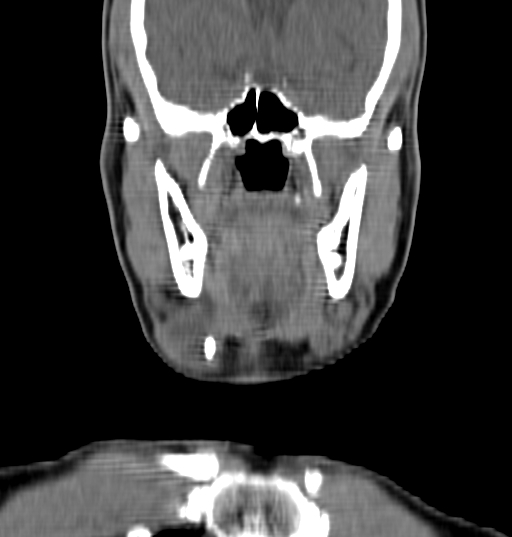 Bilateral submandibular sialolithiasis with sialadenitis (Radiopaedia 70721-80881 Coronal non-contrast 20).jpg