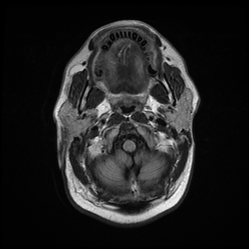 File:Bilateral thalamic glioma (Radiopaedia 65729-74848 Axial FLAIR 2).jpg