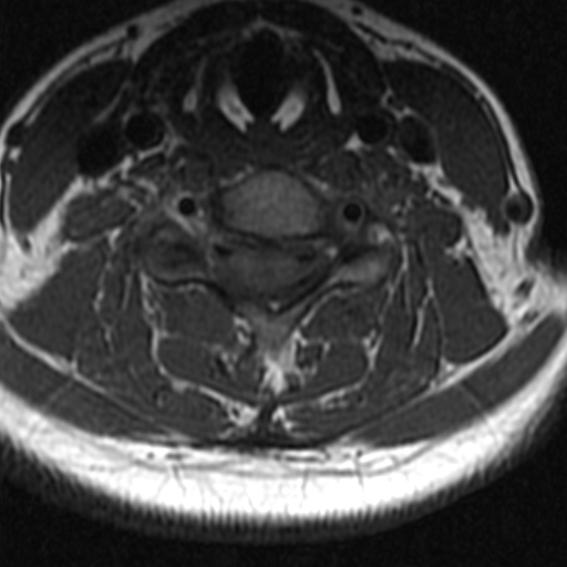 File:Bilateral tortuous vertebral arteries (Radiopaedia 19070-19039 Axial T2 6).jpg